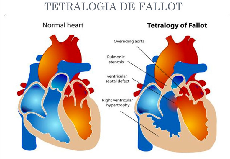 Diagrama de corazón sano contra uno con Tetralogía de Fallot